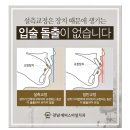 에이비씨여성의원 | 설측교정후기 티나지 않는 방법 없을까요