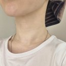 30대 육아맘 선물, 대구 피부과 나인원 디클래시 콜라겐 주사 목주름 시술 후기 (목주름필러부작용)