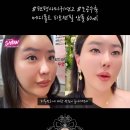 수축 | 메디폴트 피토젠필 앰플 요철 지우개 가격 모공 수축 후기