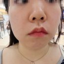 강남역 피부과 가성비 울써마지 브이로리프팅 턱선라인 관리 1주일 후기