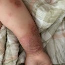 하늘소한의원 | 안양시 아토피피부염 환자들이 추천하는 의료기관 아토5분