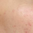 약국Revive | 좁쌀여드름 클리어틴 으로 삭제 도전해본 후기