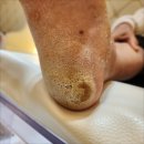 분당발각질 제거 말끔하게 잘하는 네일다움 페디크루 내성발톱 무좀 발각질 네일 문제성발 디톡스족욕
