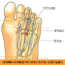 [의학 리포트] 지간신경종의 치료법과 예방법 이미지