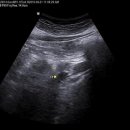 췌장 종괴와 췌장 가성 낭종(pancreas mass with psedocystic lesion) 이미지