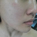 국제뷰티컨설팅 | 명지피부관리 잘하는 곳 찾았다 : 러브리뷰티 문제성피부 케어 후기