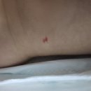 유문어린이집 | 신생아 뇌초음파 및 2개월 접종 후기 폐구균, 로타 바이러스 체리혈관종 사경 토 코막힘
