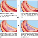 비만 나이는 45살 중년13살의 혈관 이미지