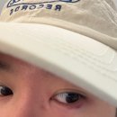 눈밑지 병원 예약과정 / 눈밑지방재배치 수술 3일차 회복기간 통증 및 관리 꿀팁 (내돈내산 후기)