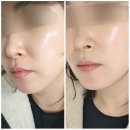 다니스킨 | 겨울철 수분관리/재생관리 물방울리프팅 구의동피부 다니스킨 관리후기