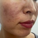 폭스 | 마이크로젯 바이오폭스 후기 2년의 고민을 끝낸 장벽 케어