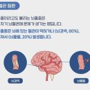 추위보다 뇌졸중의 위험도가 큰 이것조심 전조예방법 이미지