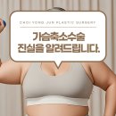 최용준성형외과의원 | 대구시내성형외과가 알려드리는 가슴축소의 진실