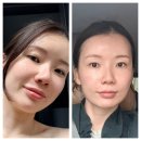인천구월동피부과 볼뉴머리프팅 600샷 후기! 팔자주름, 피부탄력 시술