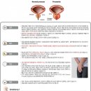 만성 전립선염 (Chronic prostatitis) 이미지
