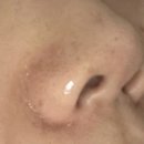 유픽의원 | 유픽의원 홍대점 아쿠아필+피코토닝 내돈내산 후기