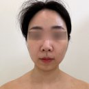 [광교윤곽관리] 아바에스테틱 _작은얼굴관리 후기, 생애 첫 윤곽관리에 만족