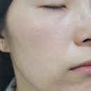 별내이마트약국 | 남양주 별내피부과 노블린레이저 기미색소치료 내돈내산 후기