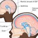 뇌수두증 원인 및 수술 (뇌수종, 물뇌증, 션트, 뇌압상승 ) 이미지