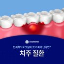 디에스다솜치과의원 | 디에스다솜치과 잇몸재생치료 치주질환 진행 단계에 따라 치료 방법이 달라질 수 있습니다.