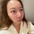 청담피부과 추천 색소레이저 비비엘 효과 (엠쥴 BBl 블랑)