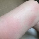 바른 | 몸이간지러워요 바디로션 꾸준히 바른 리얼 후기