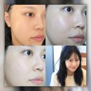 장산역피부과 해운대 셀엑소좀 블랙라벨 스킨부스터 줄기세포주사 1달 후기