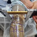 의족보조기센터 | 광주의족/ 긴 환부, 고활동성 'Taleo LP'하퇴의족 제작/ 착용후기/ 의족재활훈련