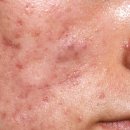 스타필의원 | 봉은사역피부과, 여드름 흉터 이 글로 종결합니다.