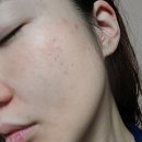 화장품 | 청소년 여드름 화장품 후기