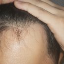 모정약국 | 나의 탈모 극복기 (현재 진행형) | 먹는 미녹시딜 프로페시아 아보다트 탈모약 부작용