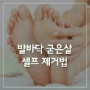 발바닥 굳은살 셀퍼 제거법 이미지