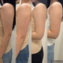 블리핏 | 구월동피부과 팔뚝지방분해주사 블리핏 가격 부작용 4회차 후기