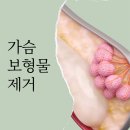 대세포차 | 가슴보형물제거, 알아야 할 모든 과정과 주의사항!