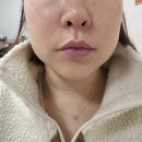 아포 | 대구 아포렉스타이트 리프팅 후기 인사이드써마지