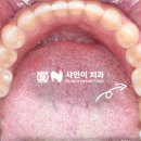 샤인치과기공소 네이버블로그