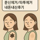 나세르의원 | [강남역 나세르의원] 문신제거/타투제거 내돈내산후기 회차별사진O