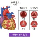 대동맥판막협착증 및 경피적 대동맥판막 치환술 이미지
