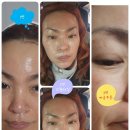 인셀덤 가성주름 없애는 법 /내돈 내산 아닌 선물 받은 인셀덤