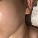 마산내서피부관리 문제성피부전문 밍스킨케어 / 피부장벽 자극 없이 케어하는 나노MTS 후기