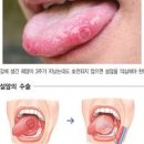 구강암 전조증상 3가지 이렇게 나타납니다 이미지