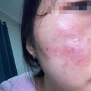 이주희에스테틱 | 티트리오일 화상? 좋다고 발랐는데 피부를 태웠어요
