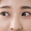 아이레이저