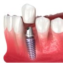 연신내치과의원 | 연신내치과추천 임플란트 저렴함? 잘하는 곳은 이렇습니다