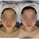어썸피부관리 - 김포시 유현로 242 | [익산피부관리] 어썸제이 하이푸리프팅 후기 | 결혼 전 익산신부관리