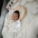 케이플러스성형외과의원 | 오체안성형외과/돌아기 멜라닌 세포모반 제거 수술 상세 후기