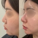 (주)지피코 1공장 | 강남역피부과에서 코필러 내돈내산 후기 신논현역 콧대필러 후기
