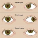 사시[strabismus] 이미지