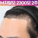 헤어라인 이미지