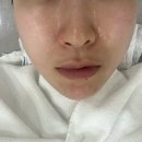 부산롯데호텔피부과 온다리프팅 5만줄 내돈내산 후기